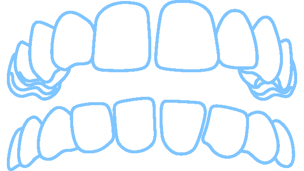Invisalign solves gaps in teeth and spacing between teeth