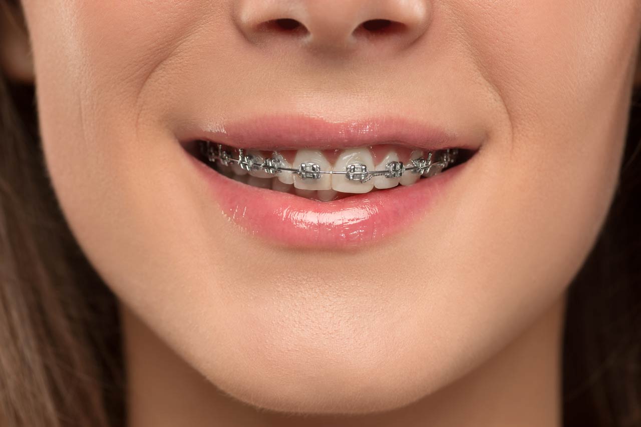 Female wearing braces in Singapore | Braces Singapore |
