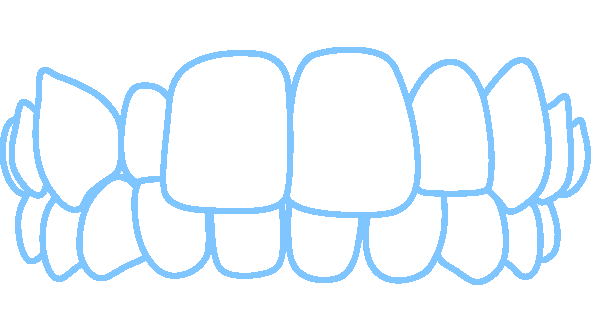 Invisalign fixes cross bites