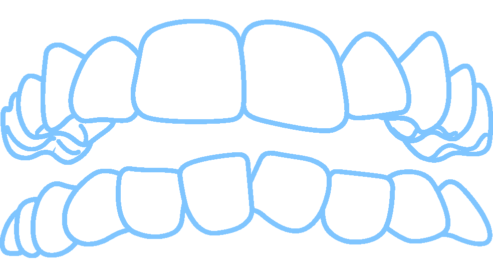 Invisalign fixes open bites