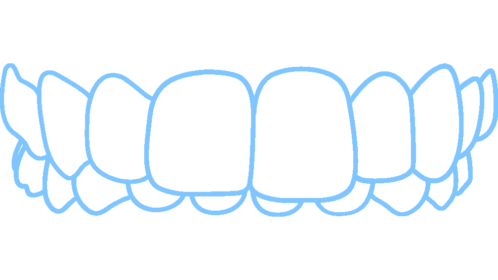 Invisalign fixes over bites