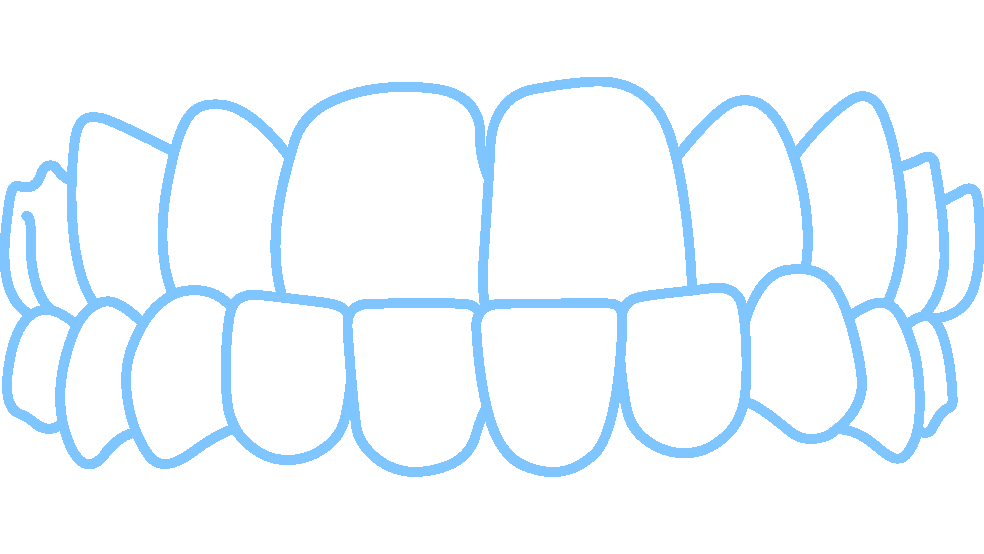 Invisalign fixes under bites