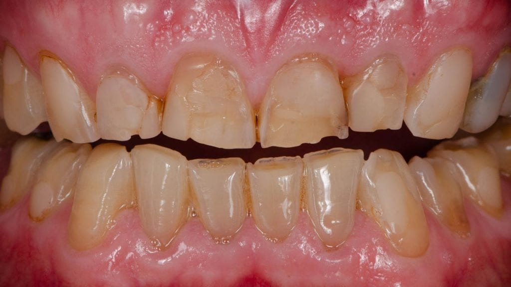 Invisalign solves gaps in teeth and spacing between teeth