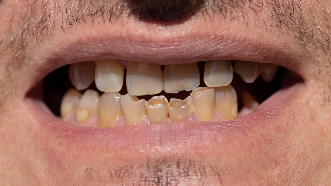 discoloured-teeth discoloured teeth due to old age