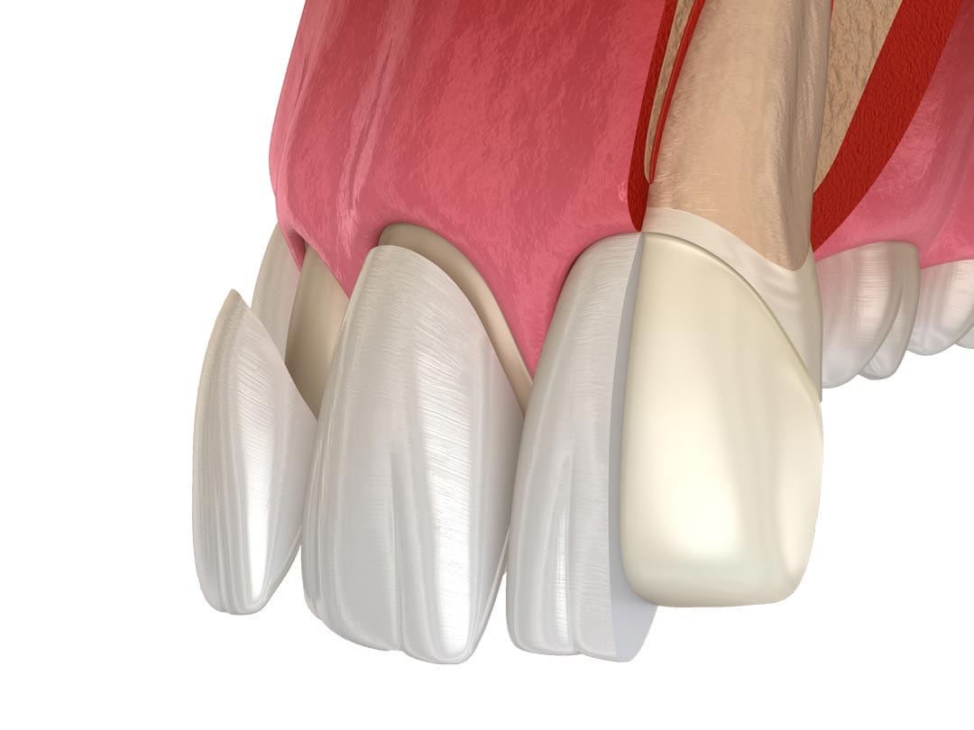 porcelain dental veneers in singapore