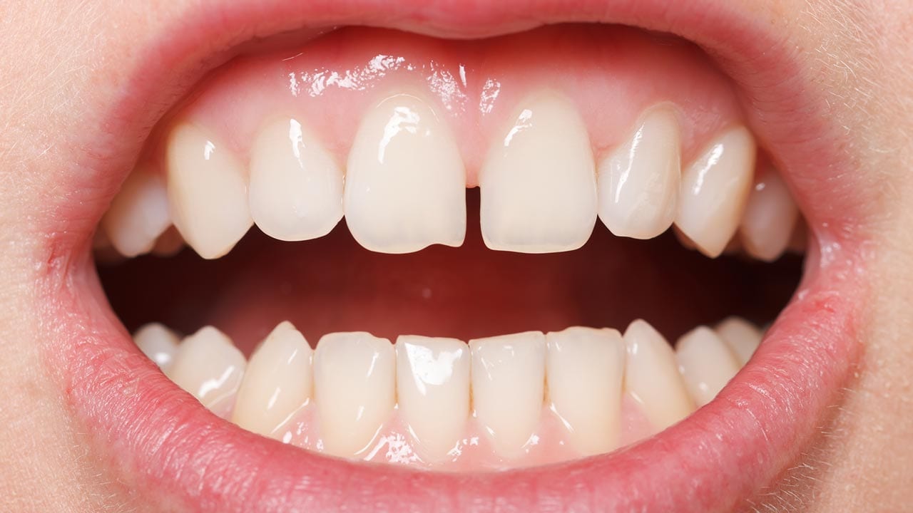 Invisalign solves gaps in teeth and spacing between teeth