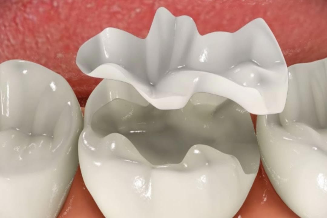 Indirect Dental Fillings Restorations - Inlays