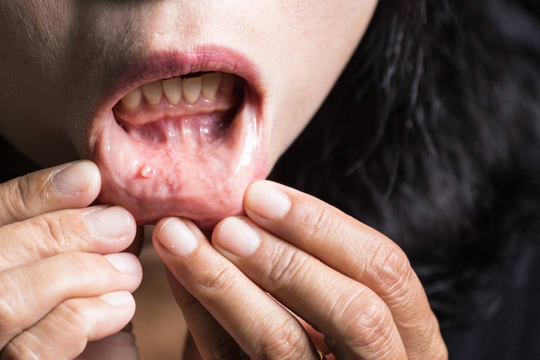 Mouth Cancer - Growth on the lips