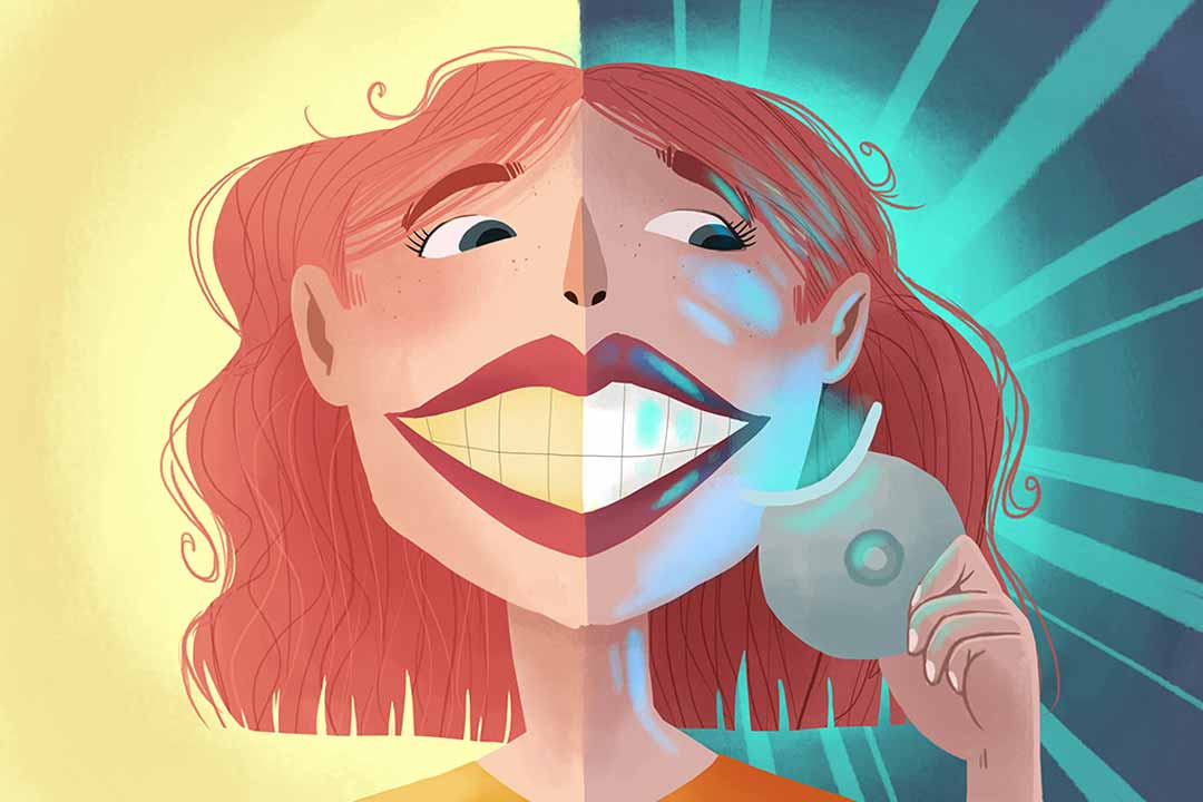 Take-home-teeth-whitening extrinsic teeth stains