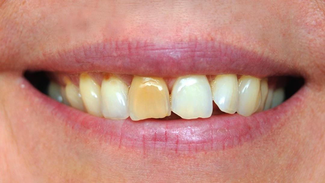 Tooth-discolouration-difference Dental veneers concealing multiple dental issues