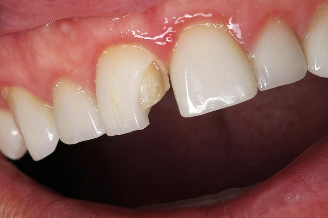 chipped-dental-veneer damaged dental veneer