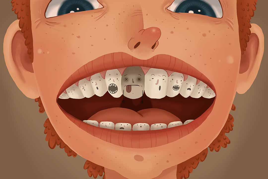 dead-tooth Intrinsic tooth stains