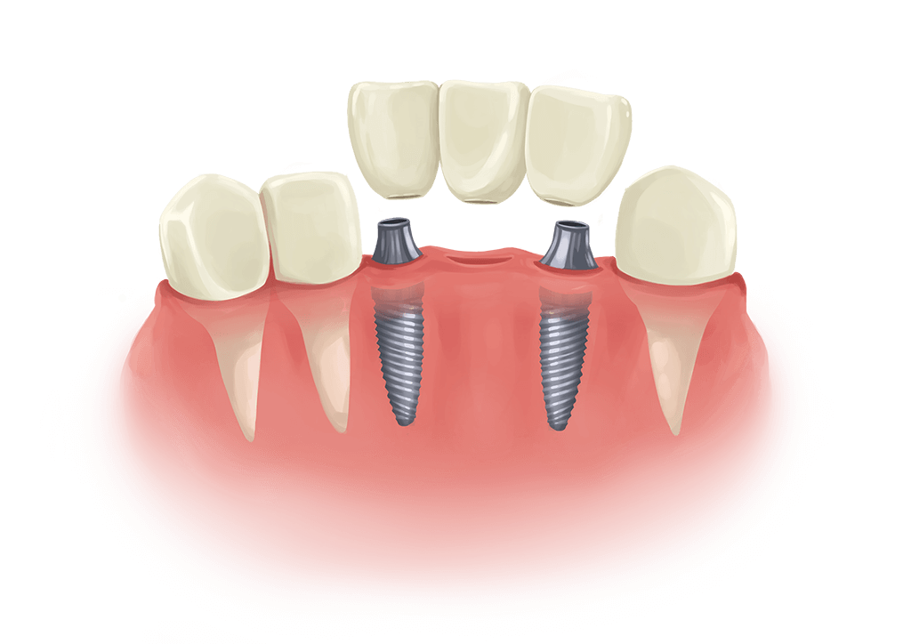 dental implant bridge cartoon dental implant bridge cartoon