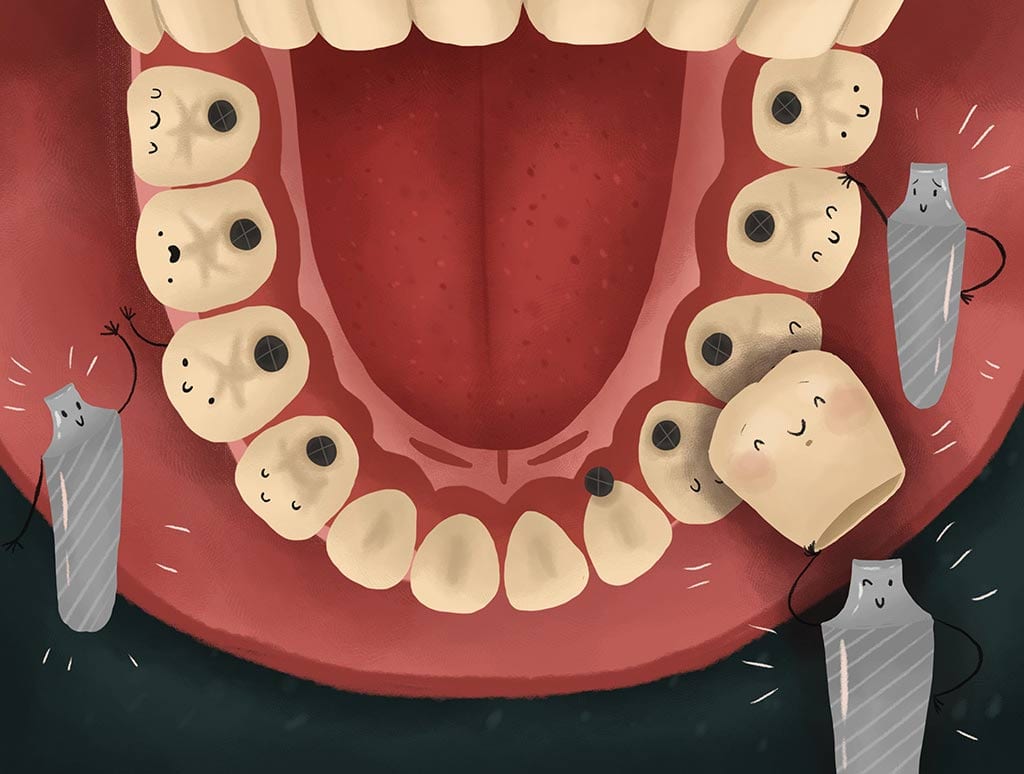 Dental Implant in mouth view graphic