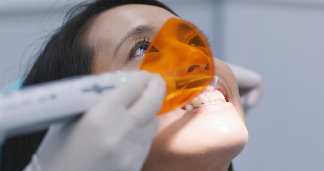 dental-restoration-and-material-polymerization-wit-9R4D2WJ Dental veneers are not Permanent - Have to be replaced once every 15 - 20 years