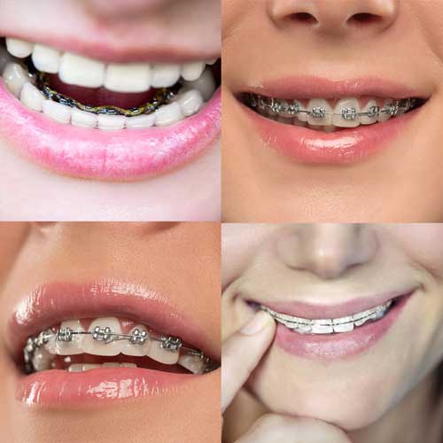 different-type-of-braces-available-in-Singapore different type of braces available in Singapore