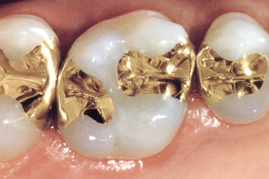 gold dental fillings in Singapore