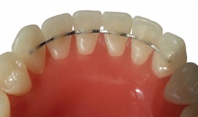 permanent lingual retainers