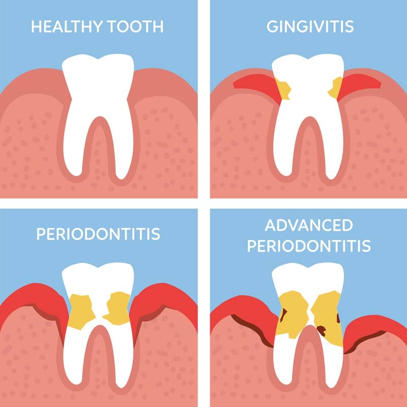 periodontal disease infographic periodontal disease infographic