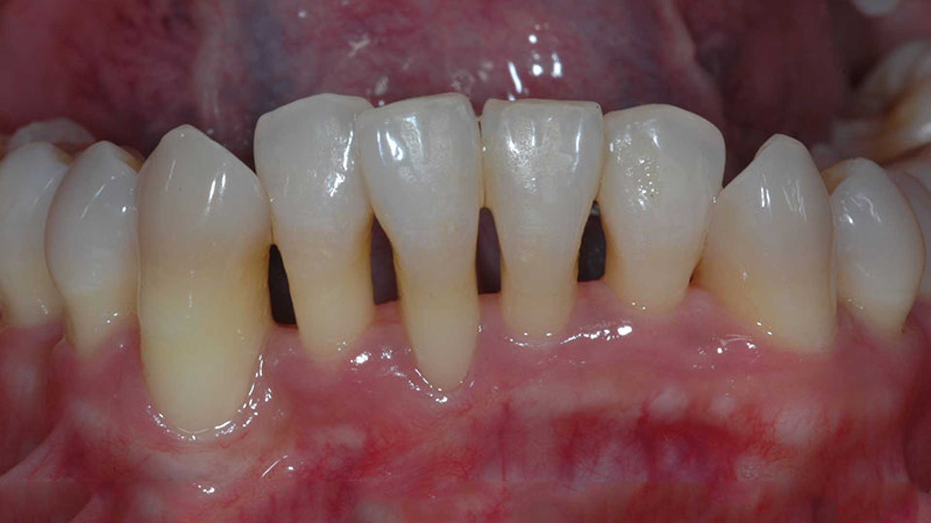 receded-gums receded gums due to gum disease