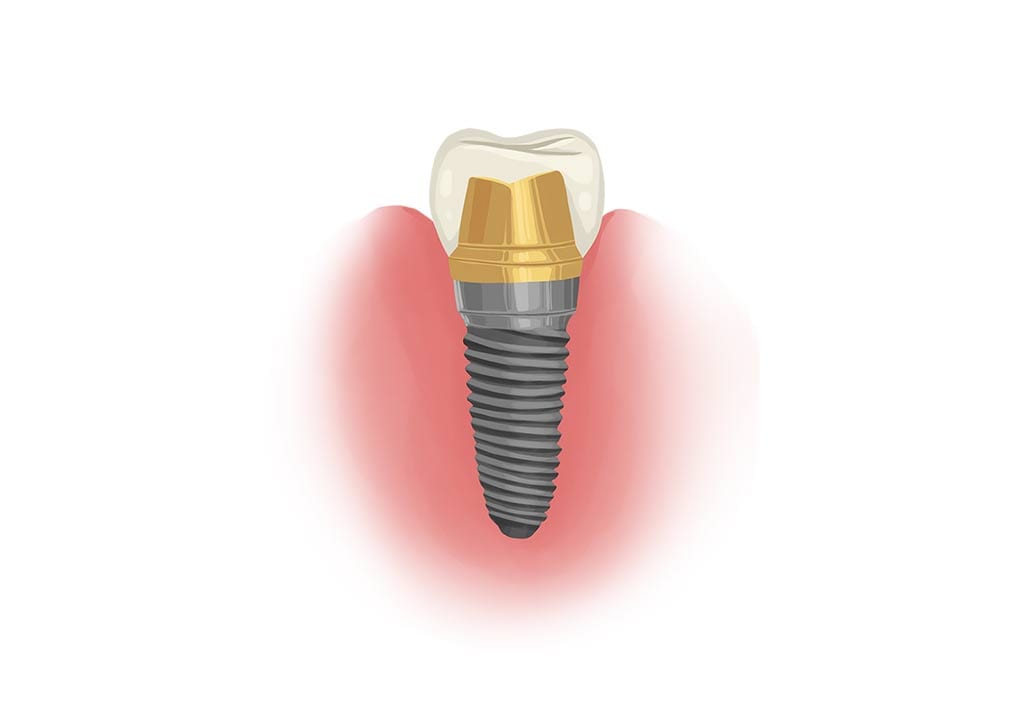 Single dental implant crown graphic
