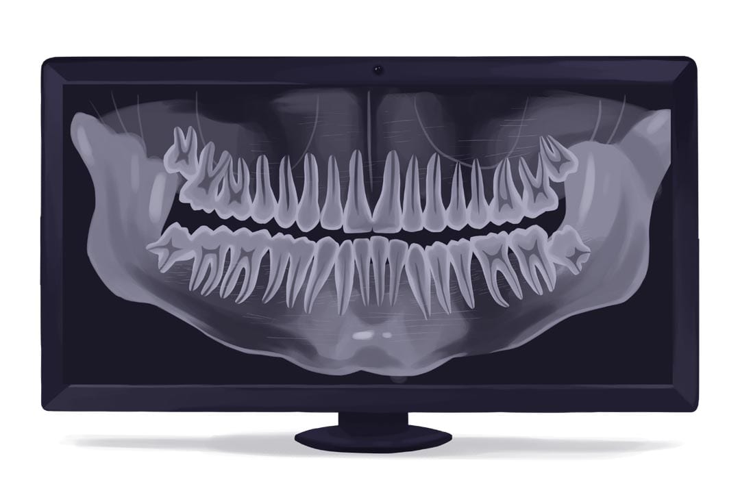 OPG xray for sinus lifts