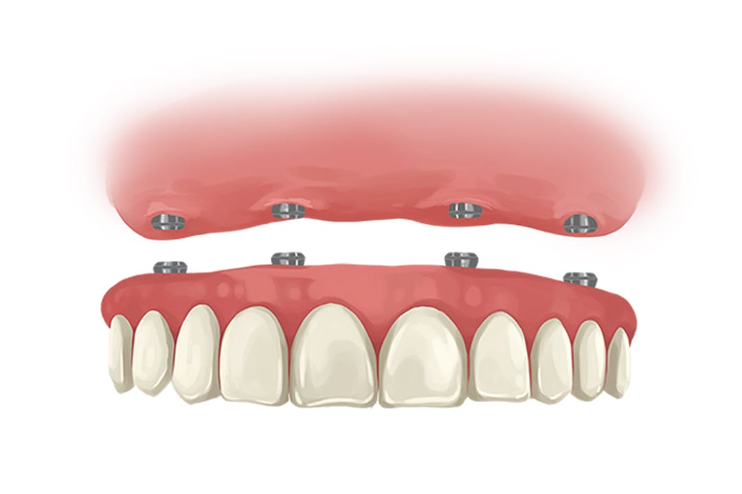all on 4 dental implant retained denture