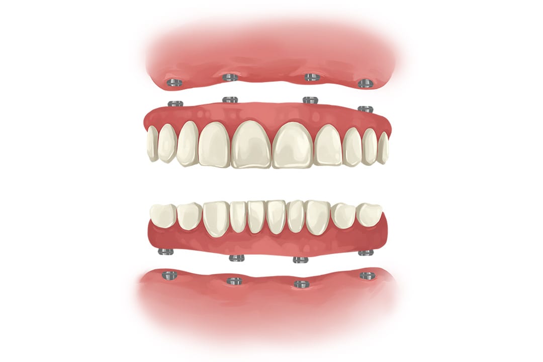 all-on-4-dental-implants-two-arches all on 4 dental implant 2 arches