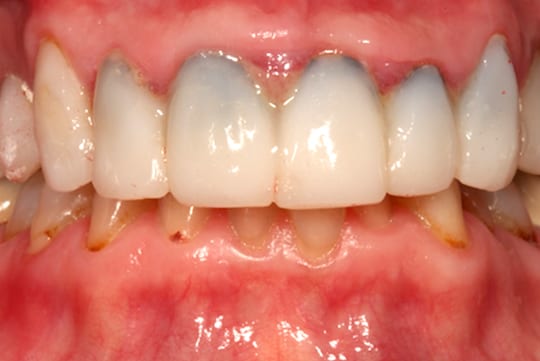 bblack-dental-margins-due-to-dental-veneers black margins due to dental veneers