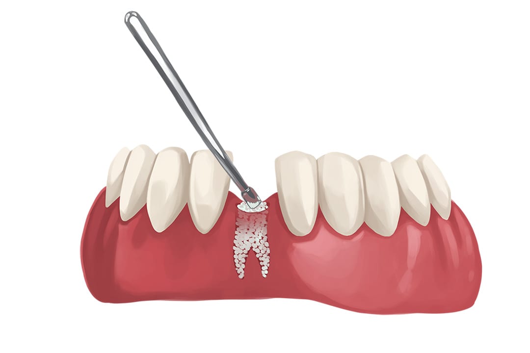 bone-graft-required-due-to-bone-loss dental bone grafting required before dental implant placement due to bone loss in the jaw