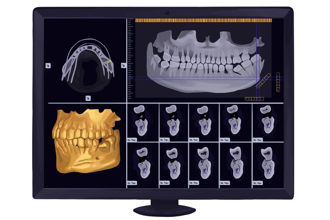 cone-beam-CT-before-sinus-lift-procedure cone beam CT for sinus lifting surgery