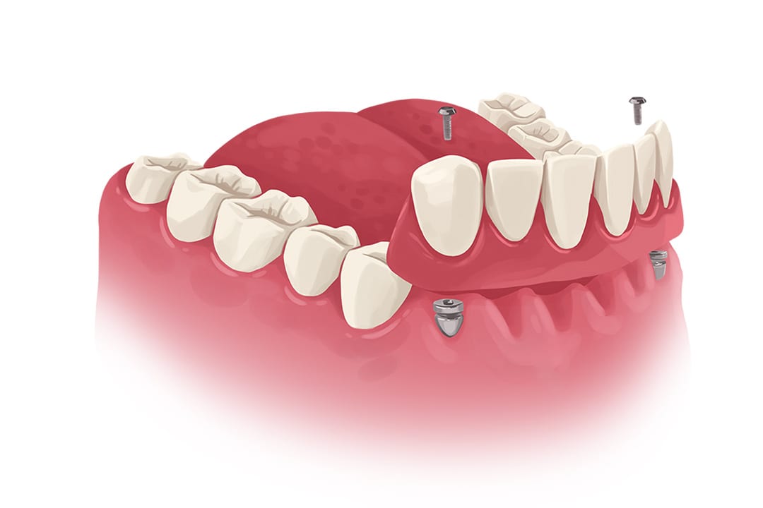 dental-implant-retained-bridge placement of implant retained bridge