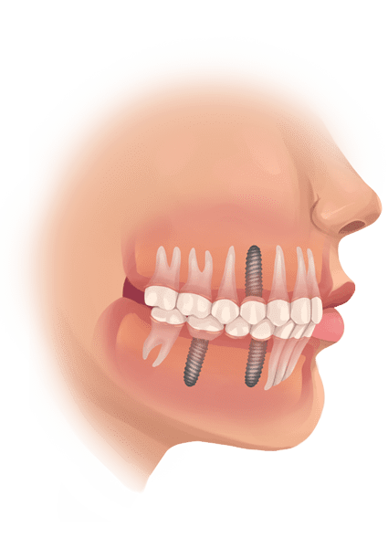 dental-implants-that-need-a-sinus-lift Sinus Lifts and Sinus Augmentation in Singapore