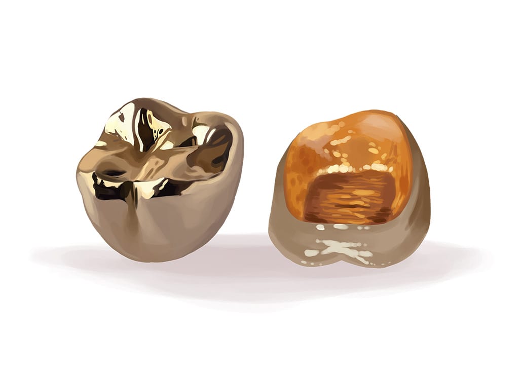 metal-dental-crown metal dental crown