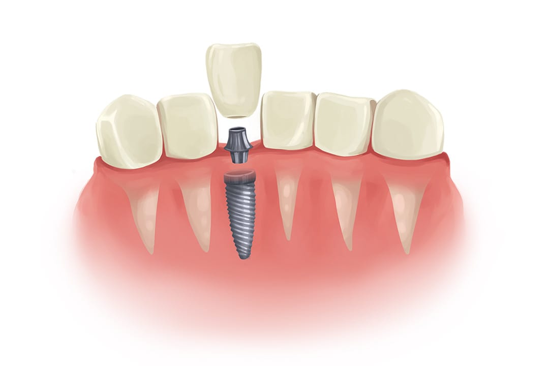 single-dental-implant single dental implant