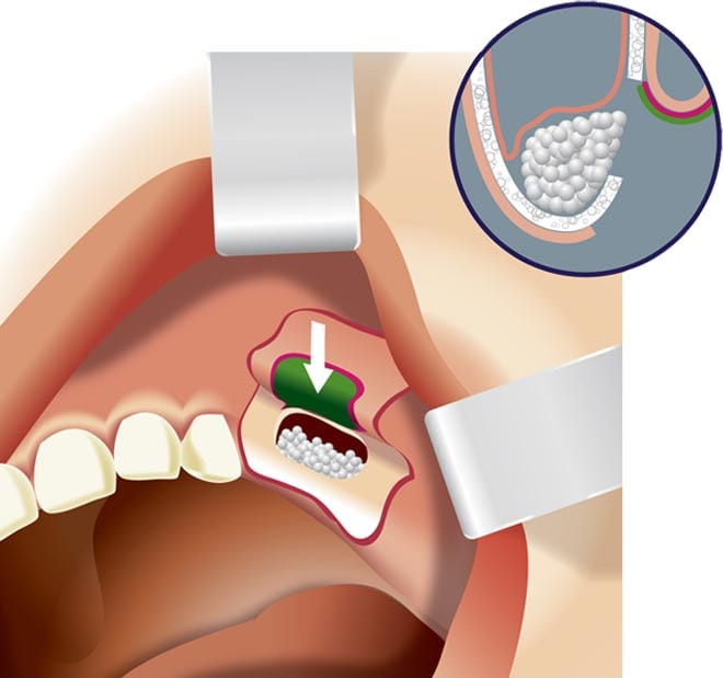 sinus-lifting-and-bone-grafting sinus lifting and bone grafting