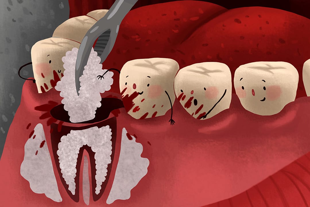 tooth-bone-graft tooth bone grafting required due to bone loss