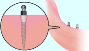 mini dental ball implants - close up of a mini dental implant