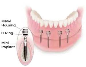 mini dental implants explained