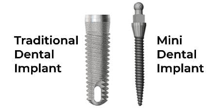 Mini dental implants vs traditional dental implants