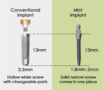 mini_implants_vs_conventional_implants (1) traditional implant size vs mini implant size