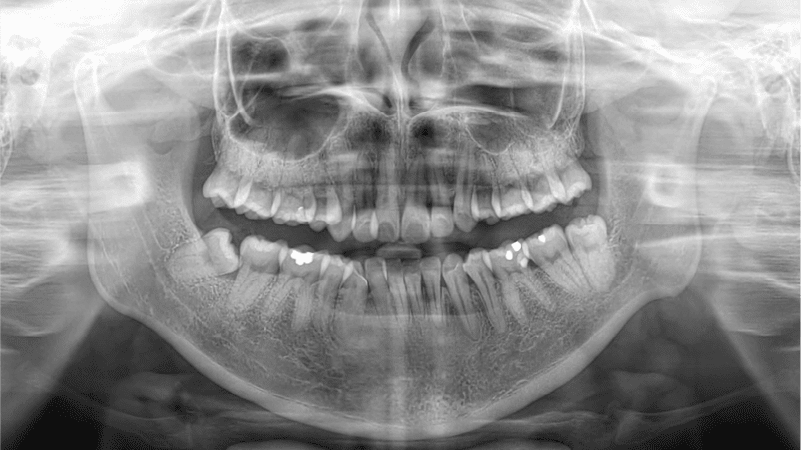 Dental xrays and 3d intraoral scanning in singapore