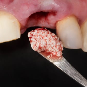 bone-grafting-in-singapore bone grafting in singapore | socket grafting