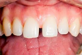 diastema2 diastema in Singapore | Treatment of Diastema in Singapore