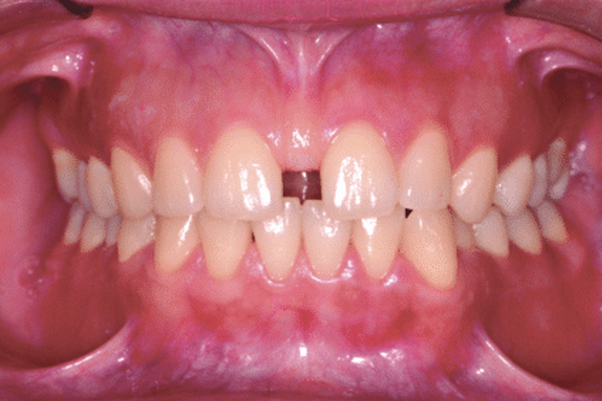 enlarged labial frenum diastema