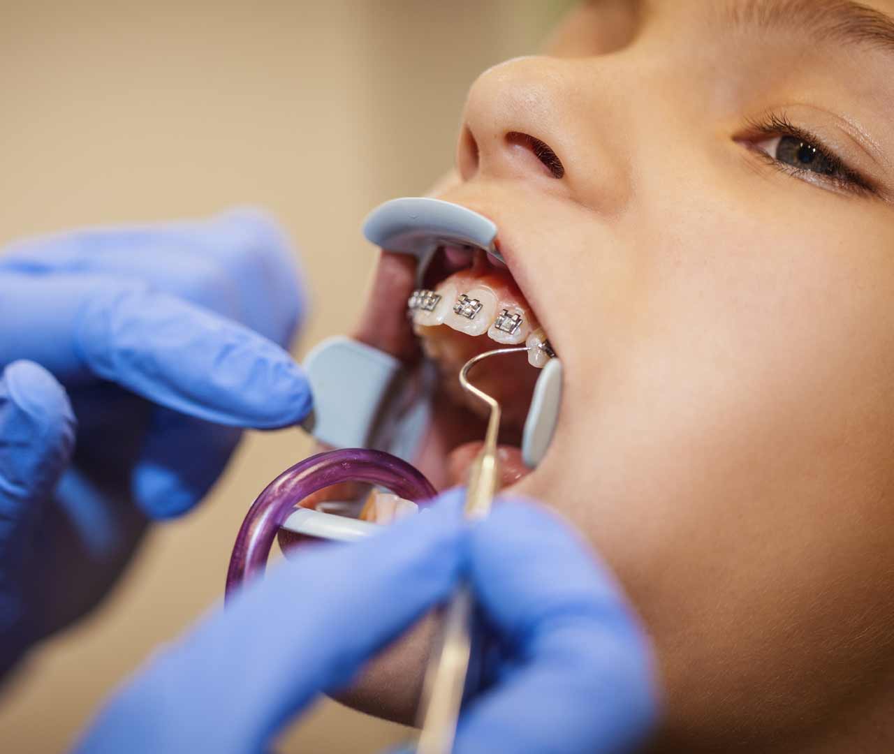 professional braces cleaning