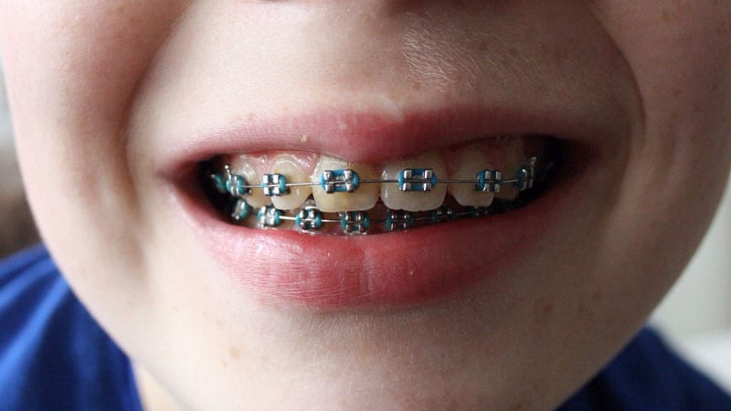 braces treatment for kids in Singapore
