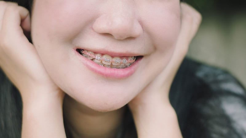 reduced discolouration of braces