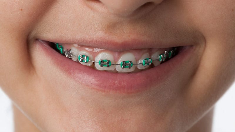 festive braces colours