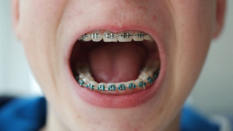 Braces colours to avoid